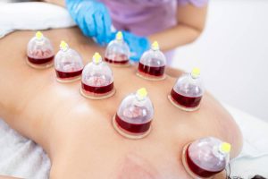 Cupping Therapy